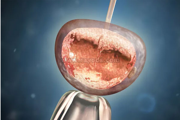 在哪些情况下多囊卵巢需要做试管婴儿